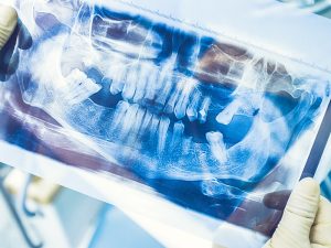 Do I really need to replace missing teeth